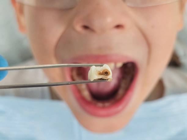 Best Emergency Tooth Extraction in Vilge St George, LA