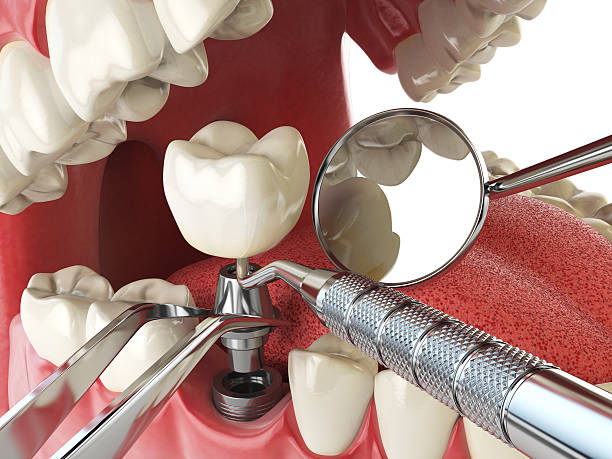 Best Emergency Dental Care for Broken or Chipped Teeth in Vilge St George, LA